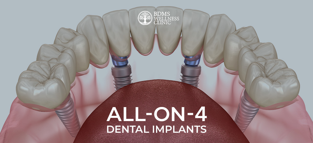 One-Day Crowns in Bangkok